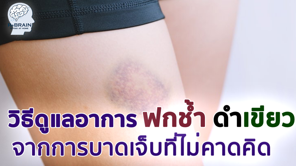 ฟกช้ำ