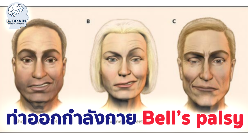 Bell’s palsy