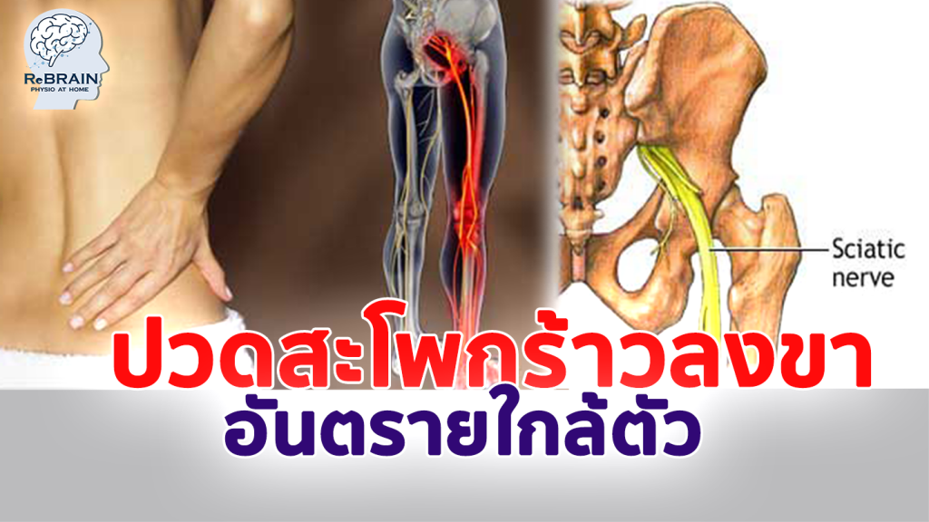 ร้าวลงขา