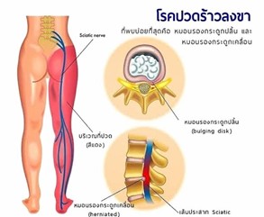 ร้าวลงขา 
