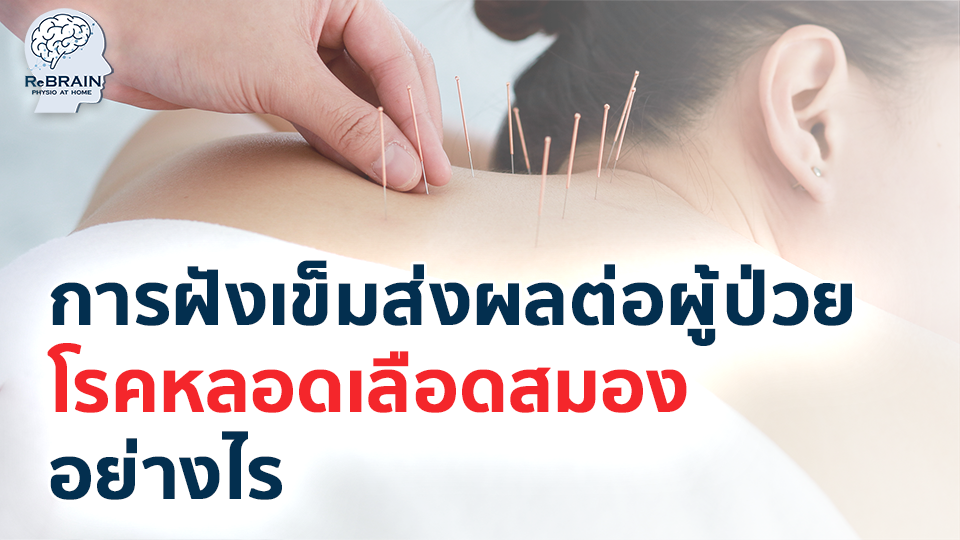 ฝังเข็ม