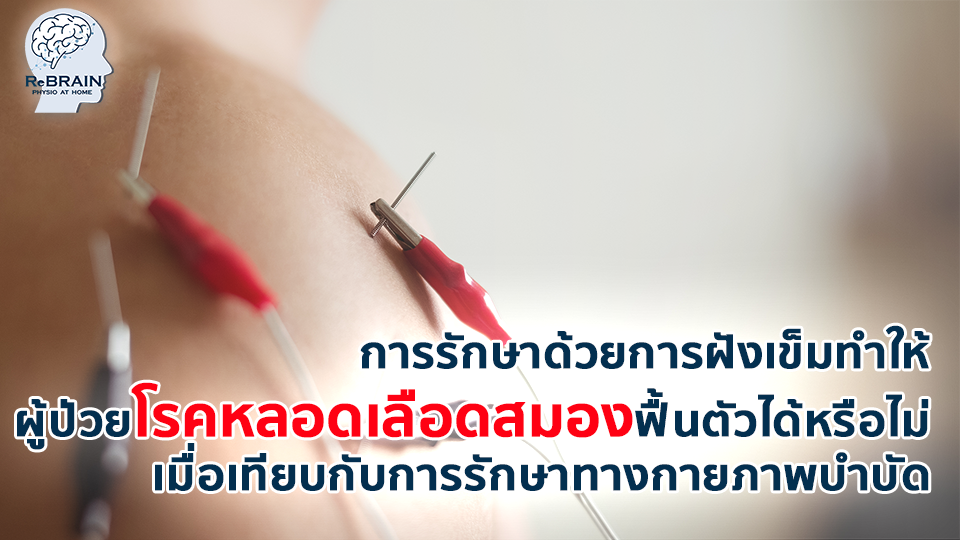 ฝังเข็ม