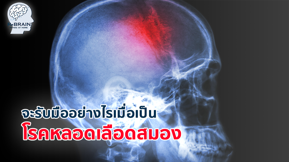 โรคหลอดเลือดสมอง