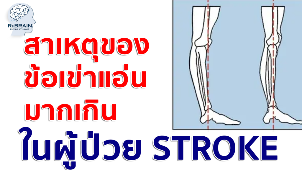 เข่าแอ่น