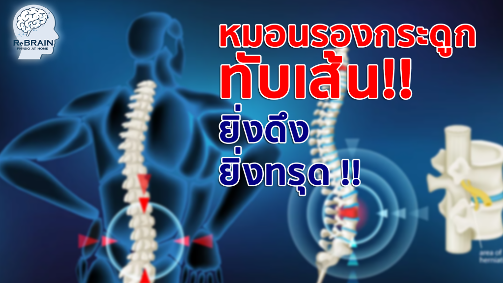 หมอนรองกระดูกทับเส้น