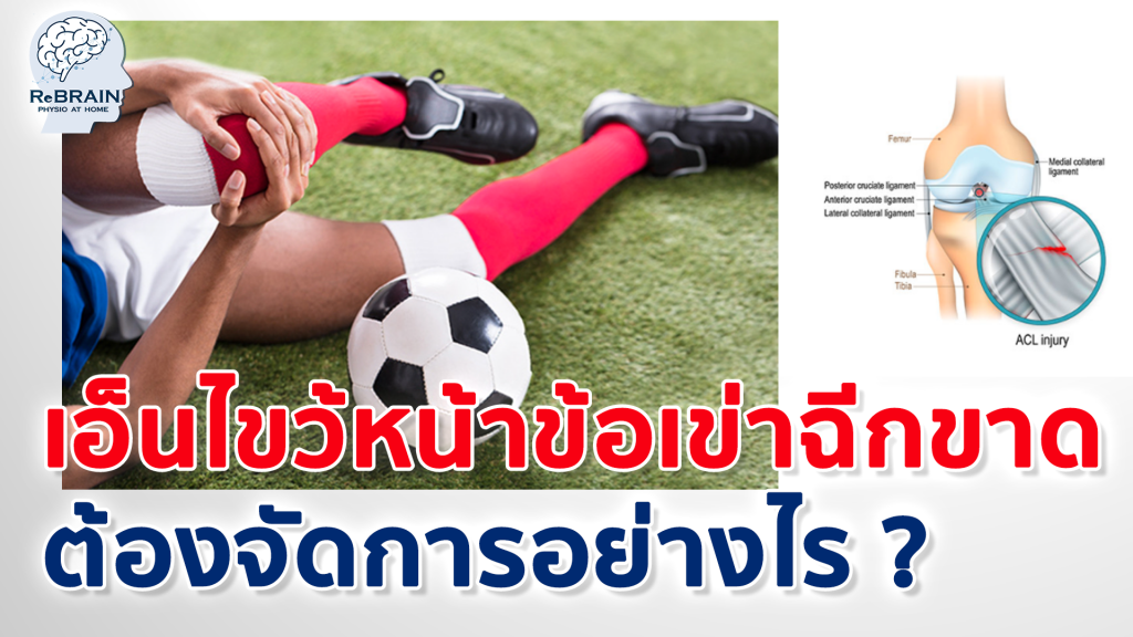 เอ็นไขว้หน้า