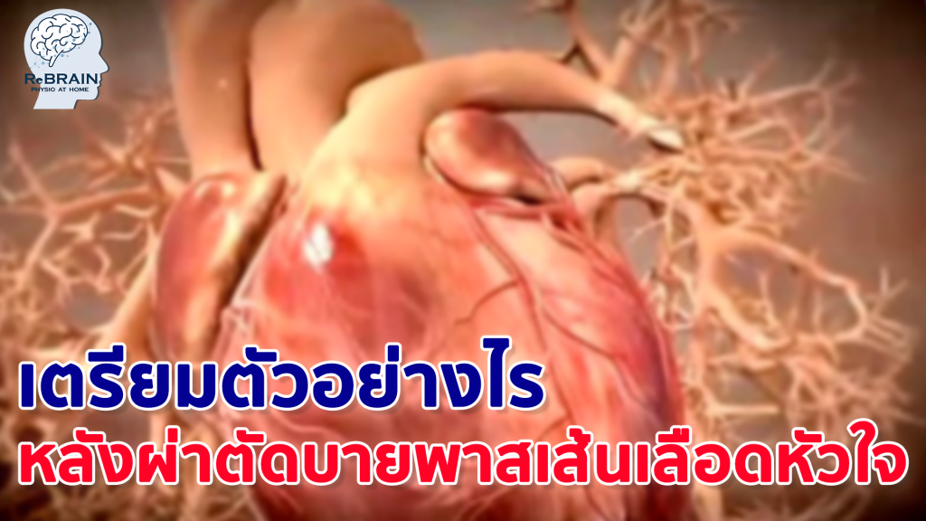 ผ่าตัดบายพาส