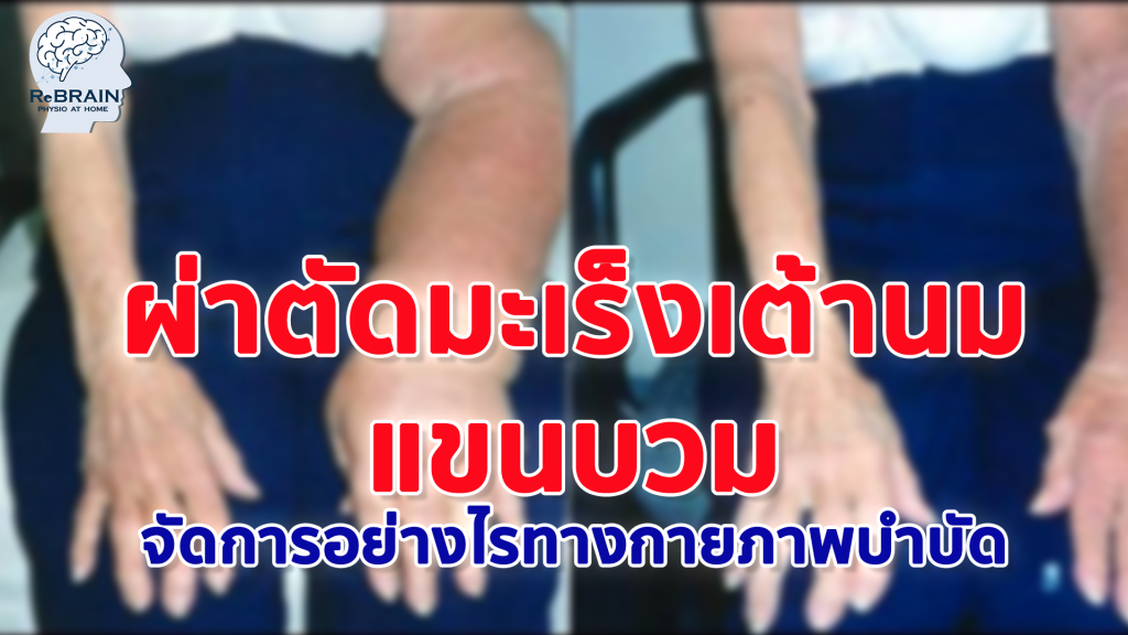 แขนบวม