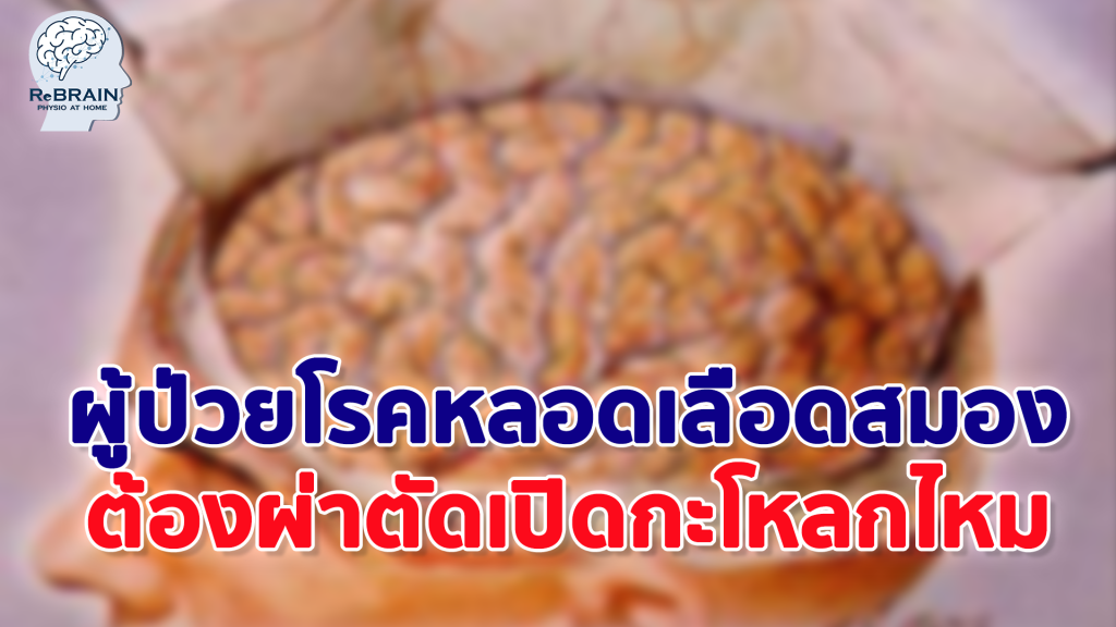 ผ่าตัดเปิดกะโหลก