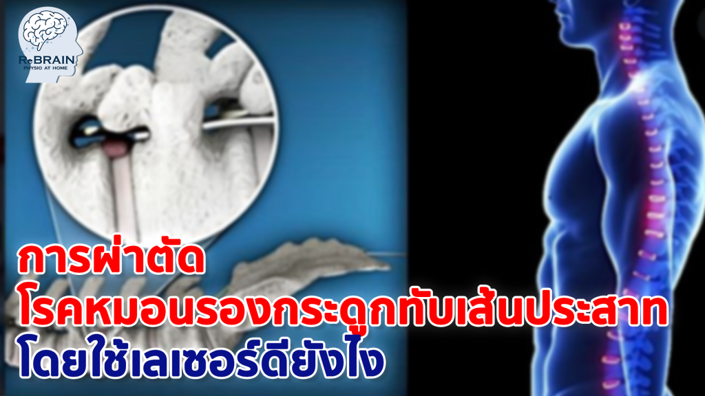 หมอนรองกระดูกทับเส้นประสาท