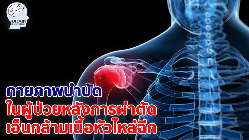 เอ็นกล้ามเนื้อหัวไหล่ฉีก