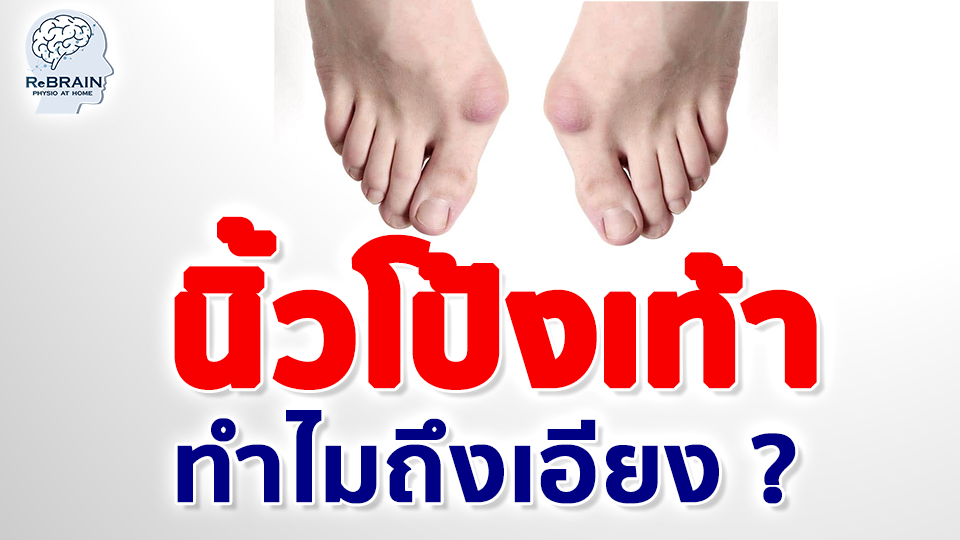 นิ้วโป้งเท้าเอียง