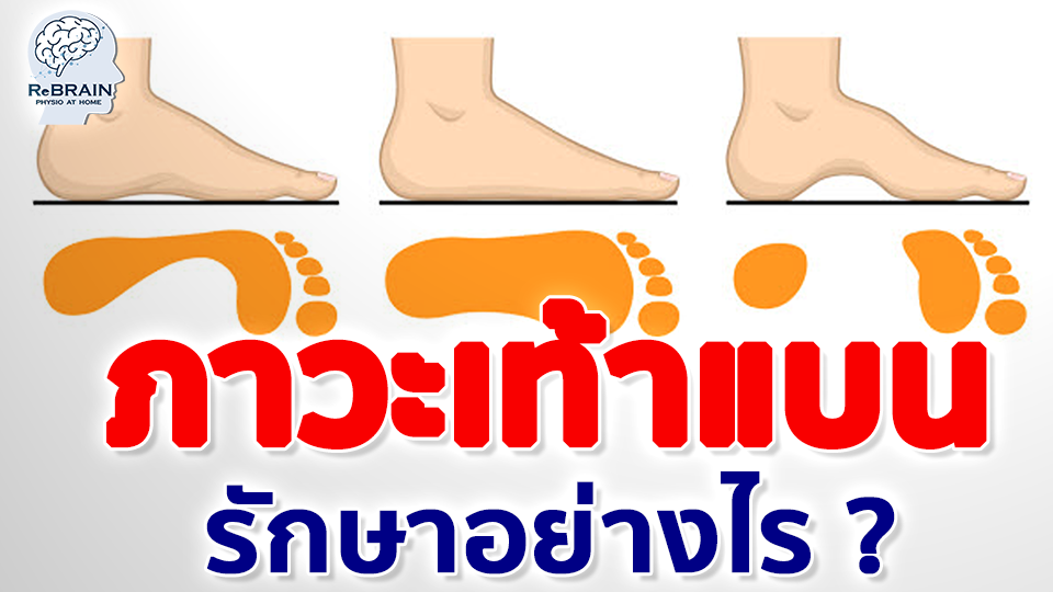 เท้าแบน