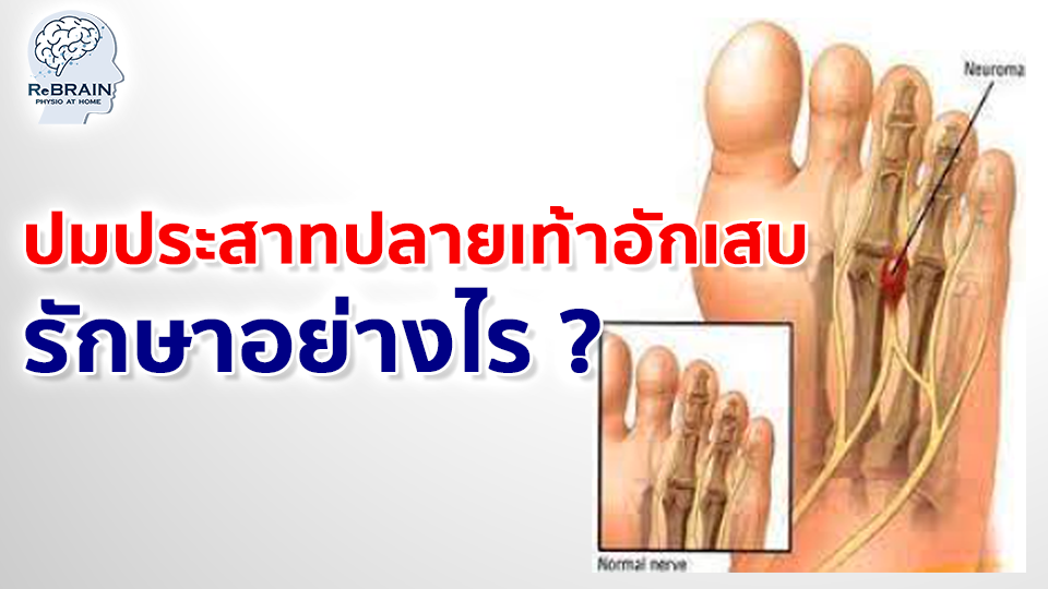ปมประสาทปลายเท้าอักเสบ