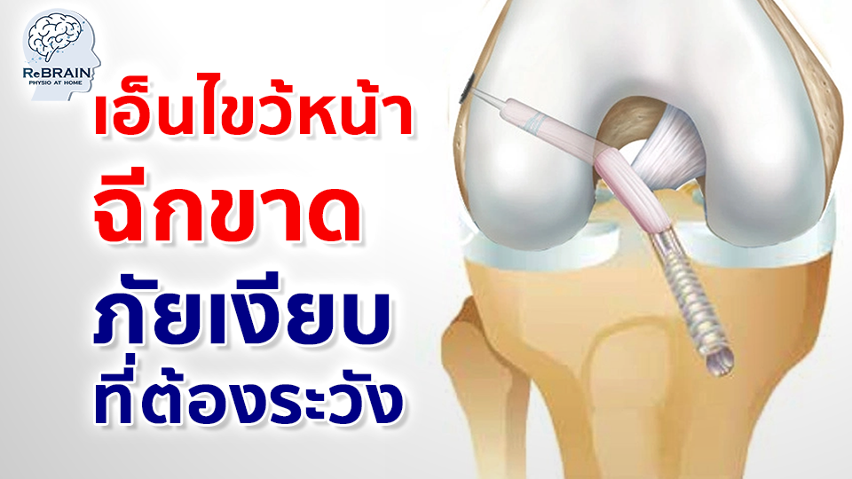 เอ็นไขว้หน้าฉีก