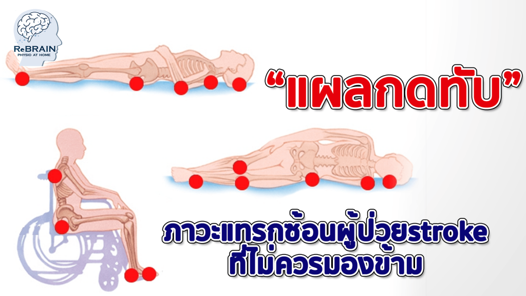 แผลกดทับ