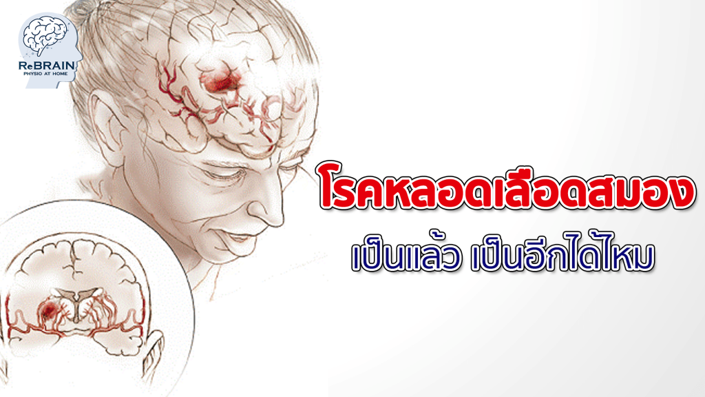 โรคหลอดเลือดสมอง