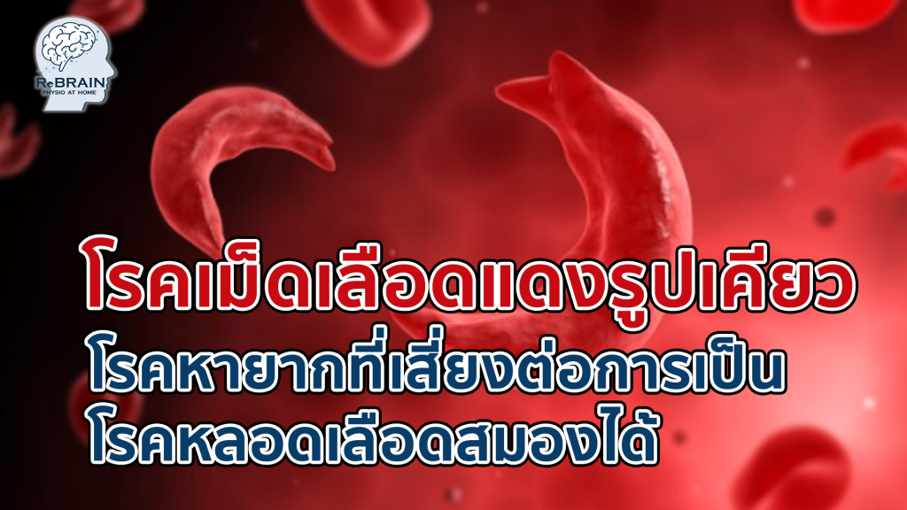 โรคหลอดเลือดสมอง