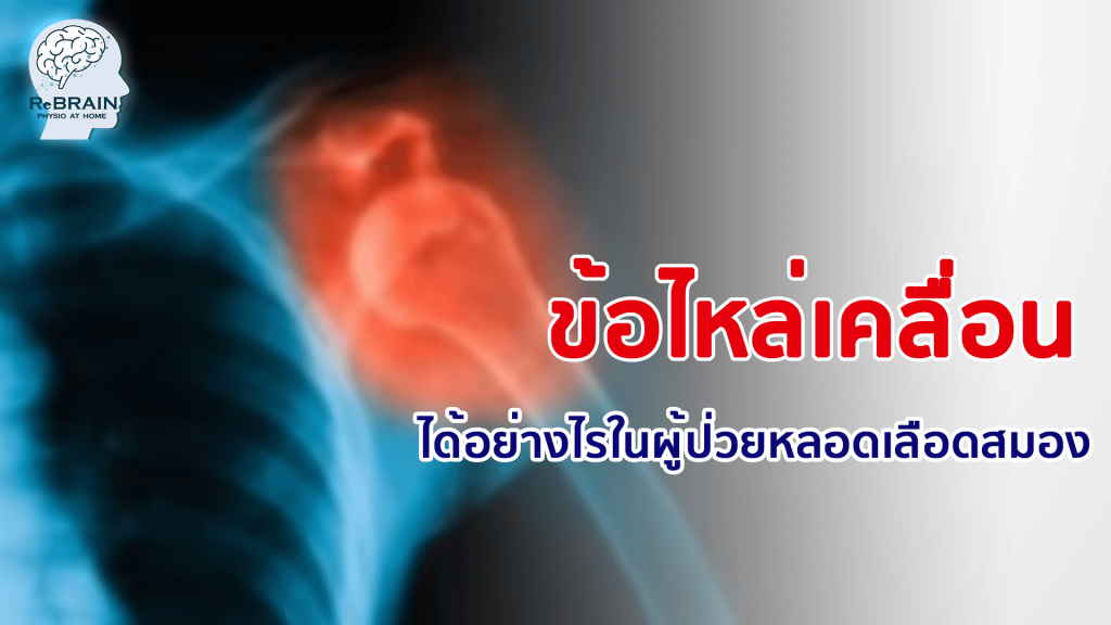 ข้อไหล่เคลื่อน