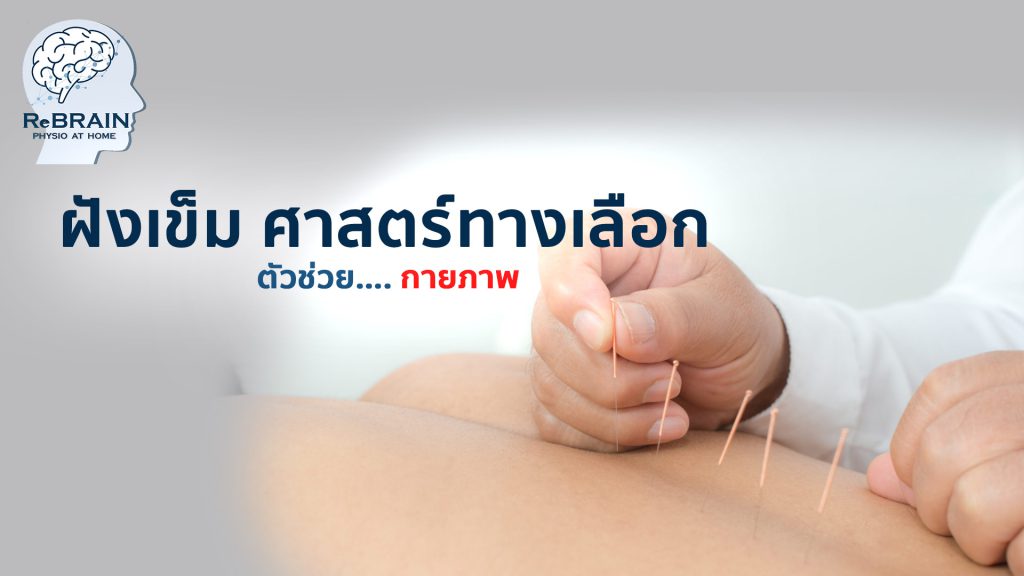 การฝังเข็ม